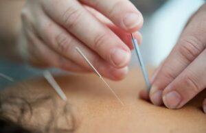 acupuntura trata diversas doenças com sucesso