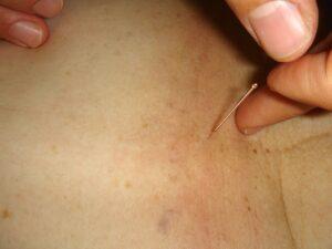 A dor do nervo ciatico pode ser tratada com acupuntura