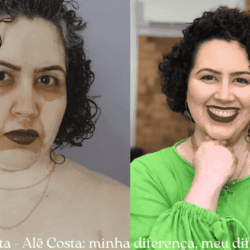 Alê Costa tem vitiligo